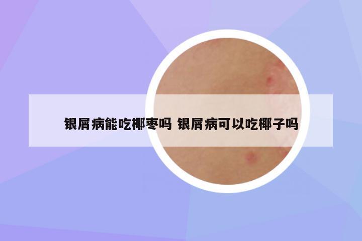 银屑病能吃椰枣吗 银屑病可以吃椰子吗