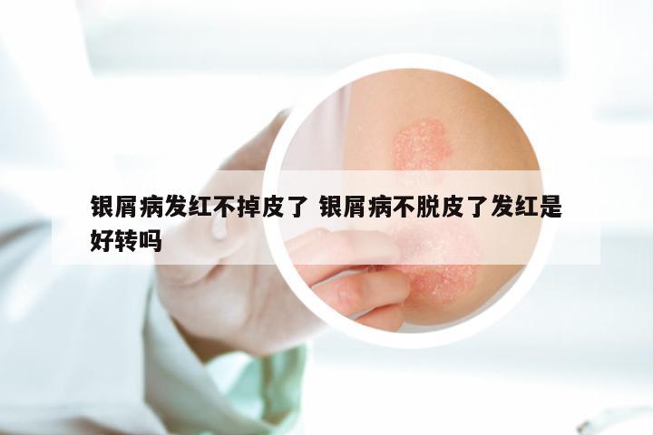 银屑病发红不掉皮了 银屑病不脱皮了发红是好转吗