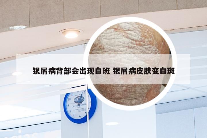 银屑病背部会出现白班 银屑病皮肤变白斑
