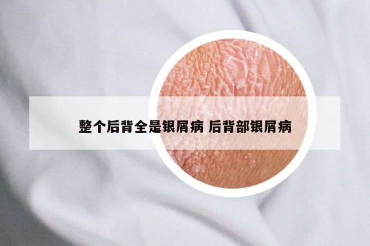 整个后背全是银屑病 后背部银屑病