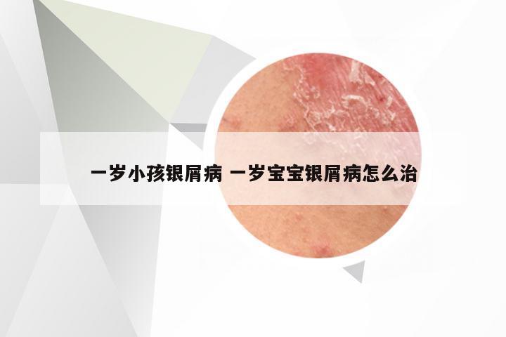 一岁小孩银屑病 一岁宝宝银屑病怎么治