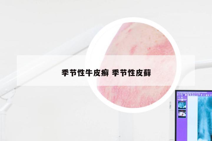 季节性牛皮癣 季节性皮藓