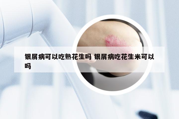 银屑病可以吃熟花生吗 银屑病吃花生米可以吗