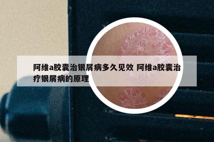 阿维a胶囊治银屑病多久见效 阿维a胶囊治疗银屑病的原理