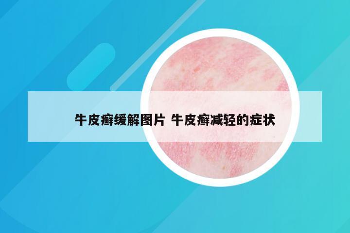 牛皮癣缓解图片 牛皮癣减轻的症状