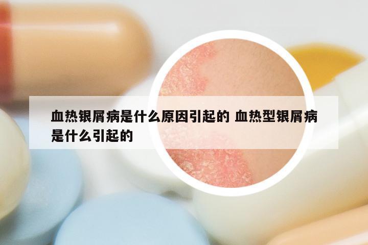 血热银屑病是什么原因引起的 血热型银屑病是什么引起的
