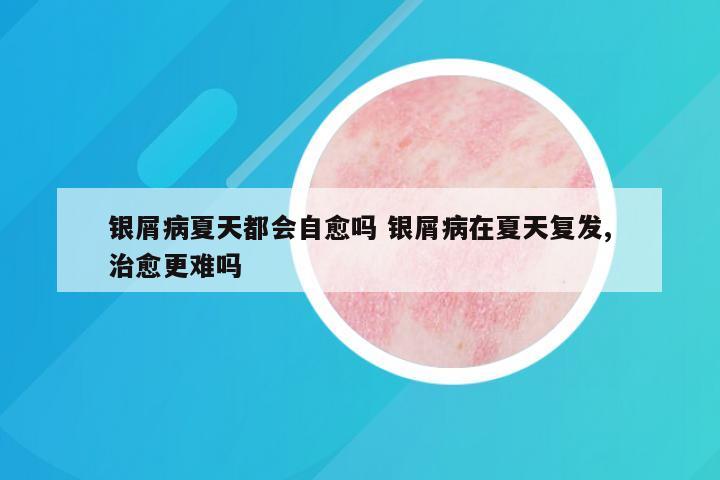 银屑病夏天都会自愈吗 银屑病在夏天复发,治愈更难吗