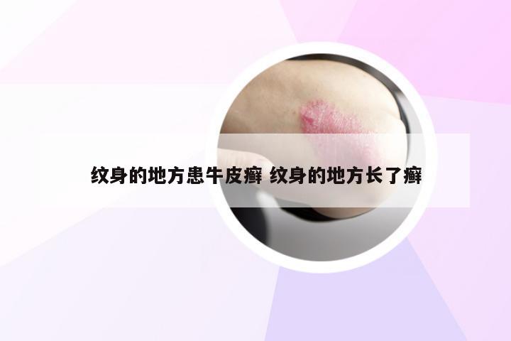 纹身的地方患牛皮癣 纹身的地方长了癣