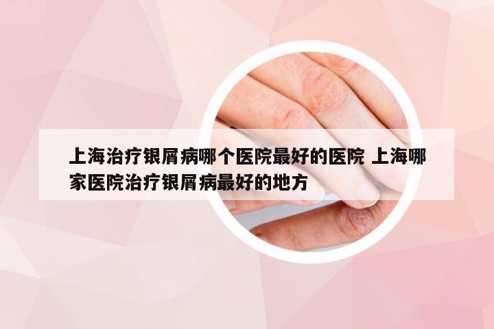 上海治疗银屑病哪个医院最好的医院 上海哪家医院治疗银屑病最好的地方