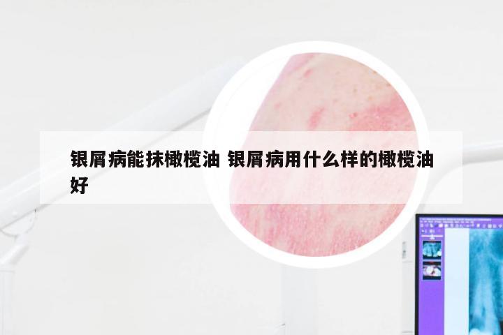 银屑病能抹橄榄油 银屑病用什么样的橄榄油好