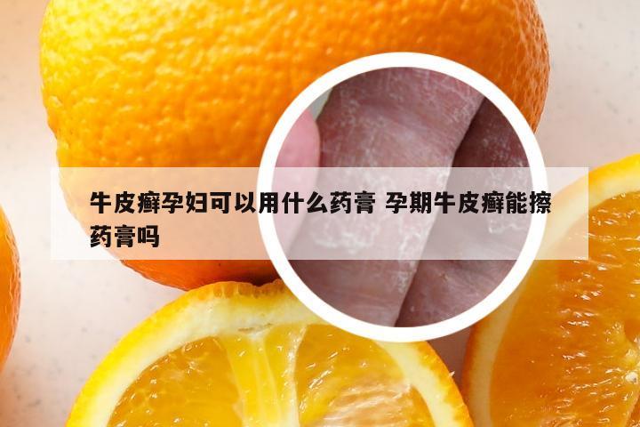 牛皮癣孕妇可以用什么药膏 孕期牛皮癣能擦药膏吗