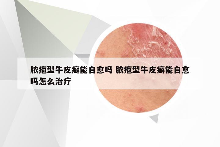 脓疱型牛皮癣能自愈吗 脓疱型牛皮癣能自愈吗怎么治疗