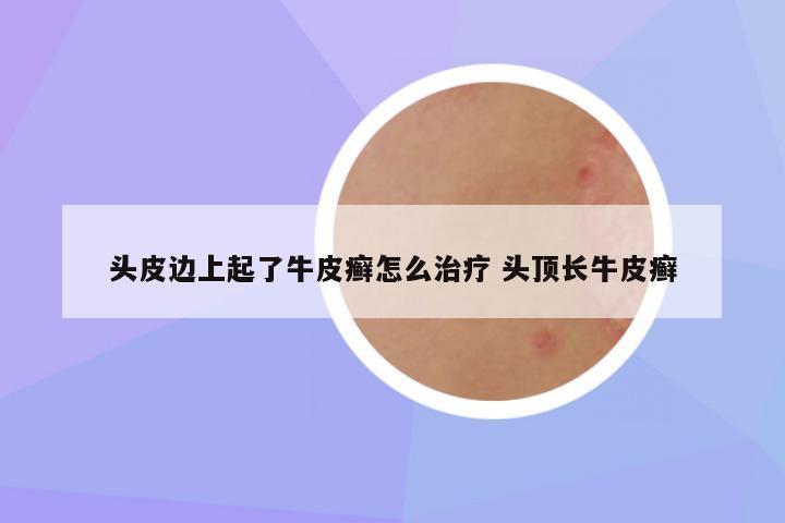 头皮边上起了牛皮癣怎么治疗 头顶长牛皮癣