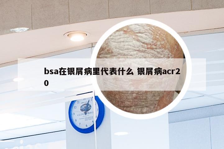 bsa在银屑病里代表什么 银屑病acr20