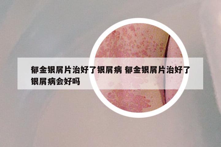 郁金银屑片治好了银屑病 郁金银屑片治好了银屑病会好吗