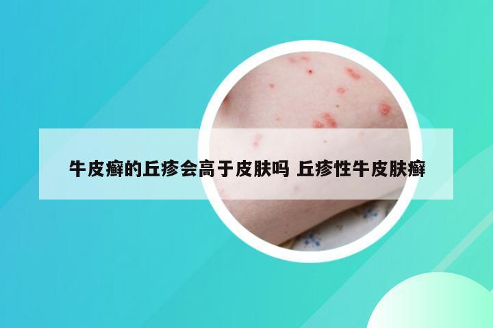 牛皮癣的丘疹会高于皮肤吗 丘疹性牛皮肤癣