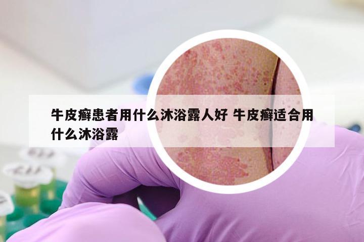 牛皮癣患者用什么沐浴露人好 牛皮癣适合用什么沐浴露
