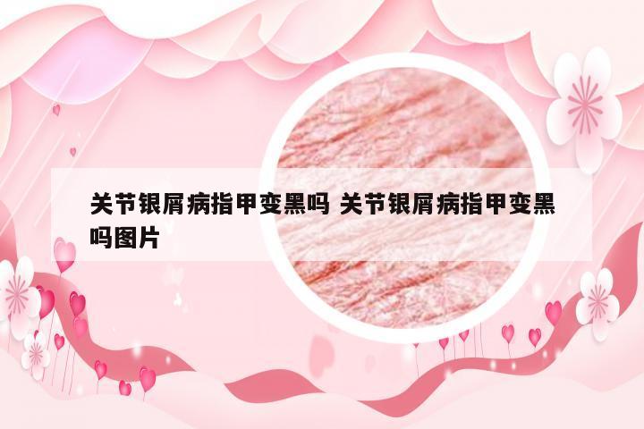 关节银屑病指甲变黑吗 关节银屑病指甲变黑吗图片