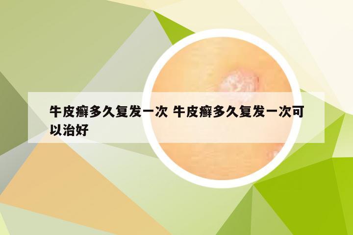 牛皮癣多久复发一次 牛皮癣多久复发一次可以治好