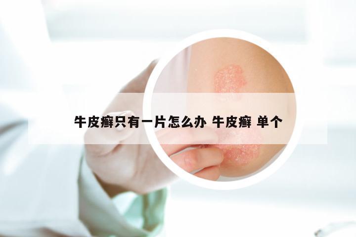 牛皮癣只有一片怎么办 牛皮癣 单个