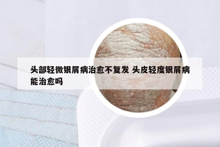 头部轻微银屑病治愈不复发 头皮轻度银屑病能治愈吗