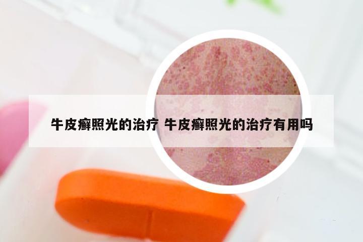 牛皮癣照光的治疗 牛皮癣照光的治疗有用吗