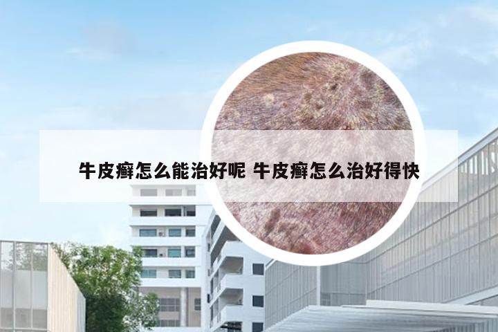 牛皮癣怎么能治好呢 牛皮癣怎么治好得快