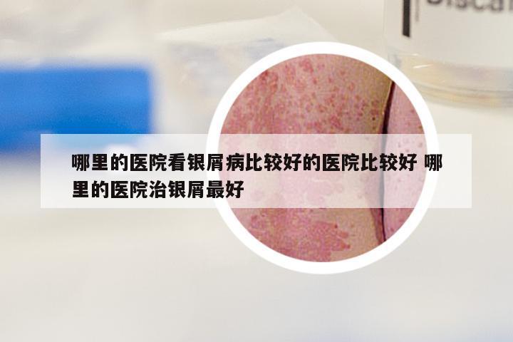 哪里的医院看银屑病比较好的医院比较好 哪里的医院治银屑最好