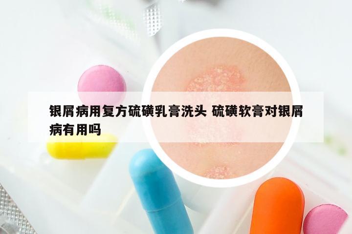 银屑病用复方硫磺乳膏洗头 硫磺软膏对银屑病有用吗