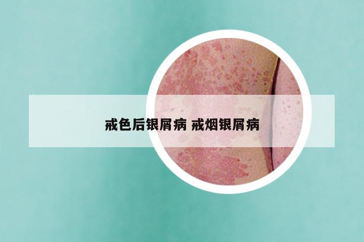 戒色后银屑病 戒烟银屑病