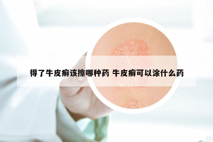 得了牛皮癣该擦哪种药 牛皮癣可以涂什么药
