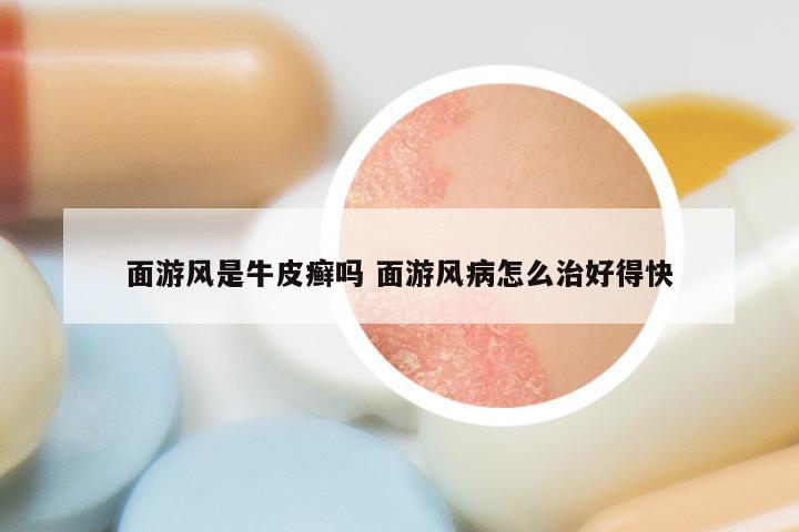 面游风是牛皮癣吗 面游风病怎么治好得快
