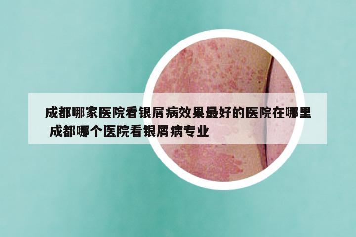 成都哪家医院看银屑病效果最好的医院在哪里 成都哪个医院看银屑病专业