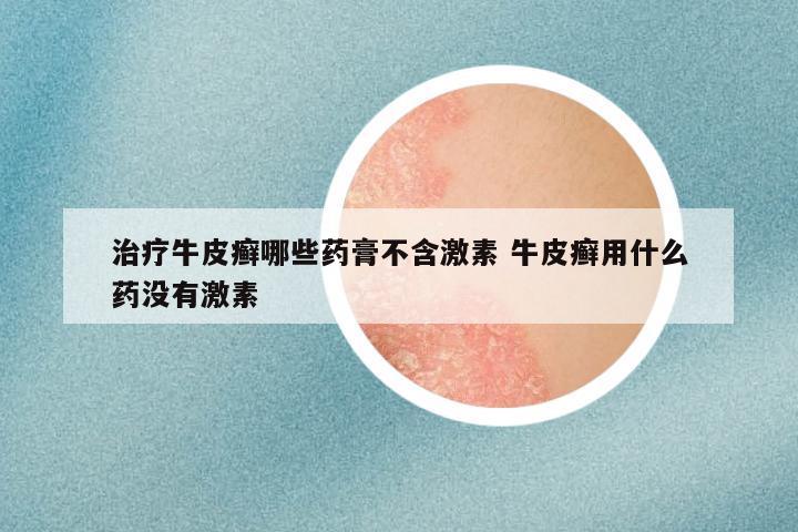 治疗牛皮癣哪些药膏不含激素 牛皮癣用什么药没有激素