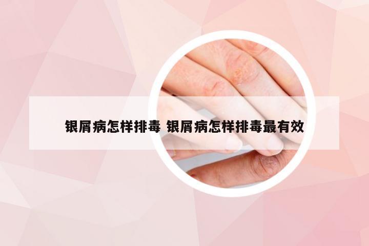 银屑病怎样排毒 银屑病怎样排毒最有效