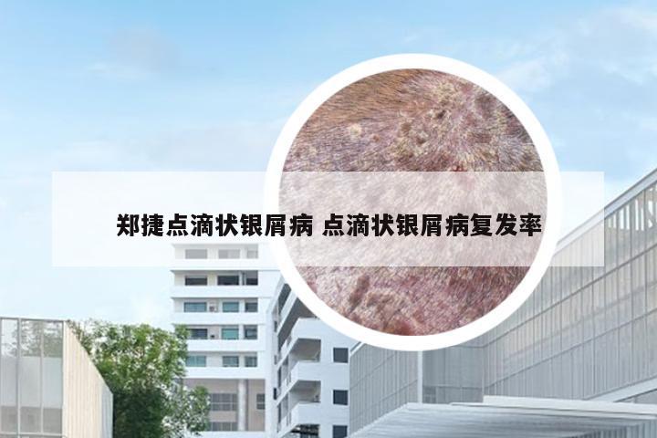 郑捷点滴状银屑病 点滴状银屑病复发率