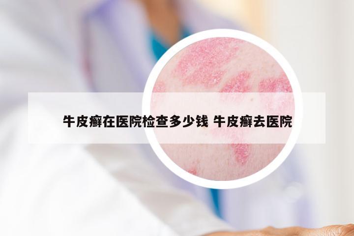 牛皮癣在医院检查多少钱 牛皮癣去医院