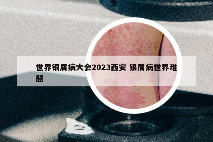 世界银屑病大会2023西安 银屑病世界难题