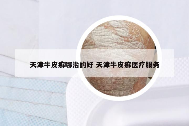 天津牛皮癣哪治的好 天津牛皮癣医疗服务