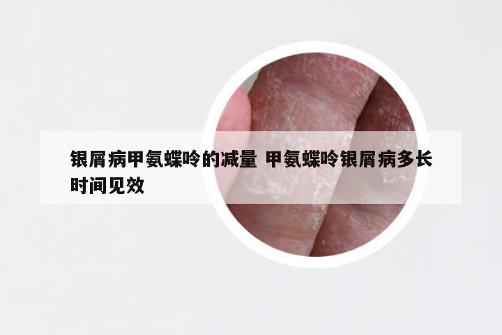 银屑病甲氨蝶呤的减量 甲氨蝶呤银屑病多长时间见效