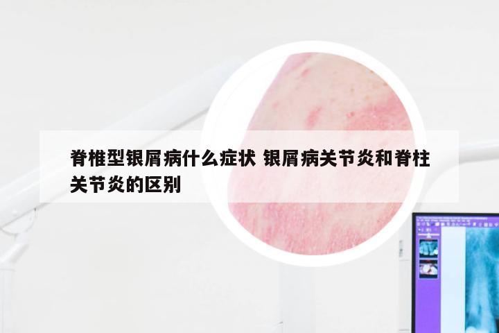 脊椎型银屑病什么症状 银屑病关节炎和脊柱关节炎的区别