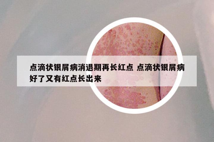 点滴状银屑病消退期再长红点 点滴状银屑病好了又有红点长出来