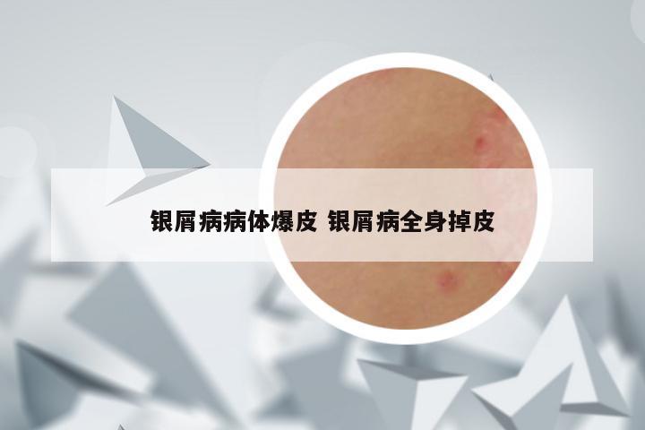 银屑病病体爆皮 银屑病全身掉皮