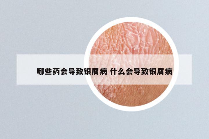 哪些药会导致银屑病 什么会导致银屑病