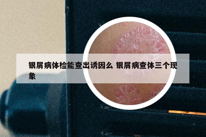 银屑病体检能查出诱因么 银屑病查体三个现象