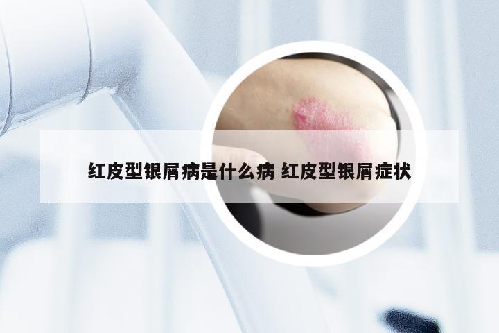 红皮型银屑病是什么病 红皮型银屑症状