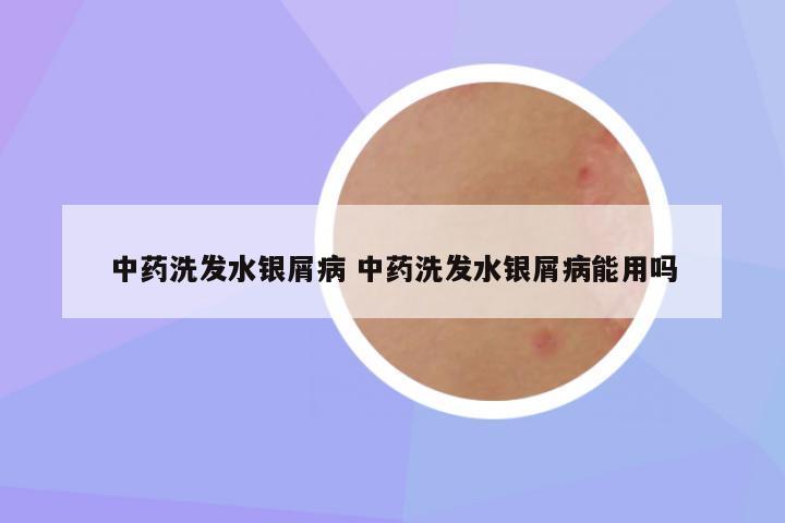 中药洗发水银屑病 中药洗发水银屑病能用吗
