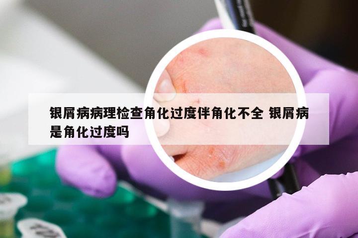 银屑病病理检查角化过度伴角化不全 银屑病是角化过度吗