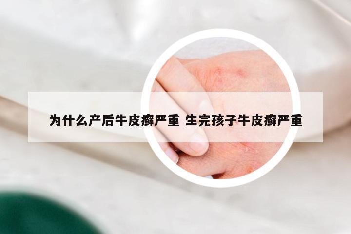 为什么产后牛皮癣严重 生完孩子牛皮癣严重