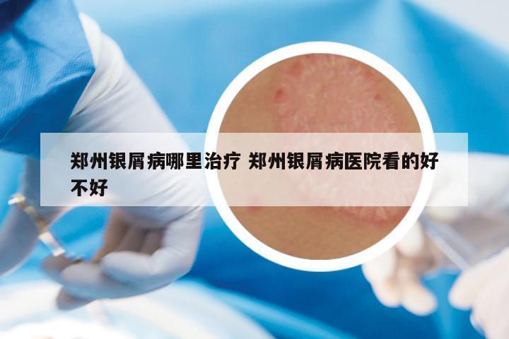 郑州银屑病哪里治疗 郑州银屑病医院看的好不好